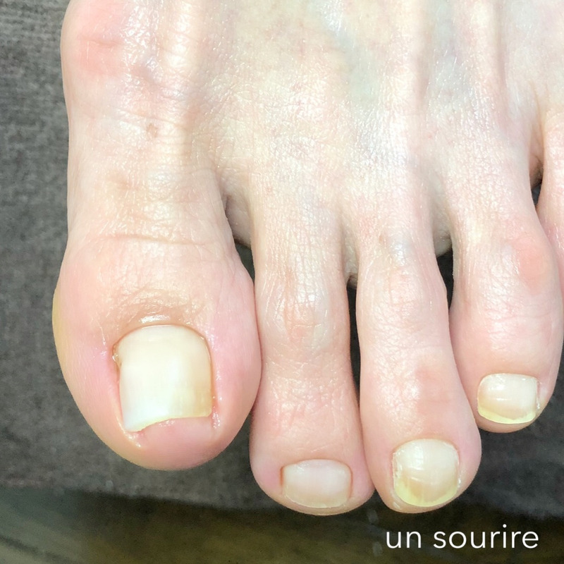 巻き爪カット・補正