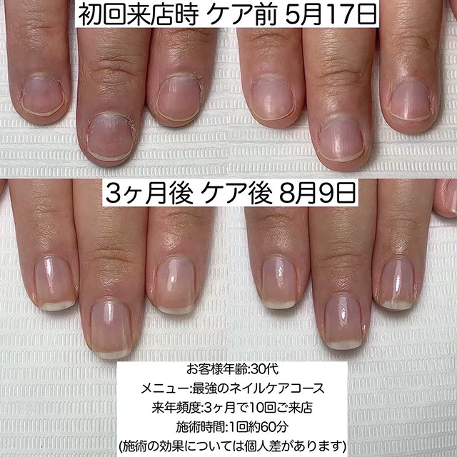 1.小さい爪、丸い爪、貝爪、深爪、平たい爪などのお悩み爪に特化した『最強のネイルケア』導入店