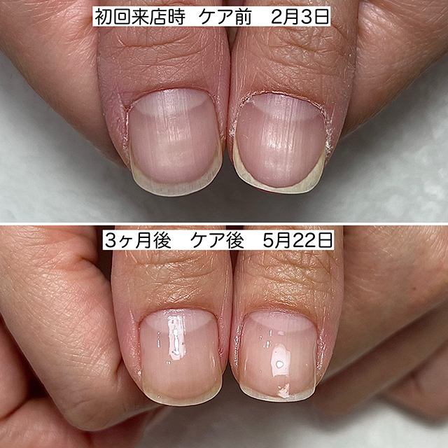 2.二枚爪、すぐ欠けるなどの弱い爪を丈夫な爪に